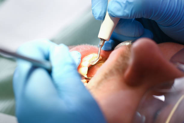 Best Emergency Dentist for Knocked-Out Tooth in Redding, CA